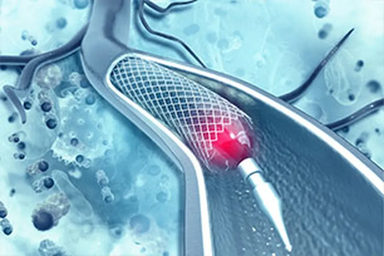 Stent Stent | Cardiac Center of Texas