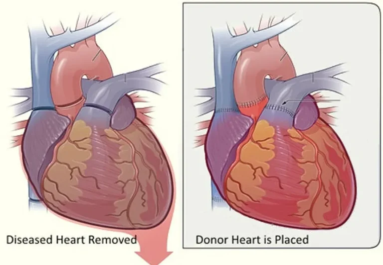 Heart transplant evaluation